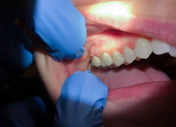 Best Knocked-Out Tooth (Avulsed Tooth) Treatment in Clarksville, VA